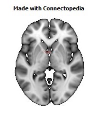 Anterior_Commissure108