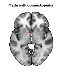 Anterior_Commissure110