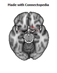 Anterior_Commissure122