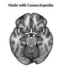 Anterior_Commissure124