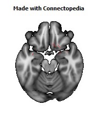 Anterior_Commissure126