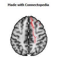 Anterior_corona_radiata_R062