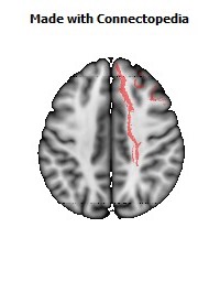 Anterior_corona_radiata_R066