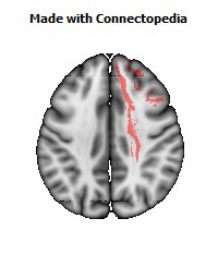 Anterior_corona_radiata_R070