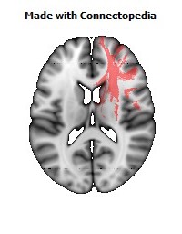 Anterior_corona_radiata_R092