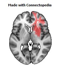 Anterior_corona_radiata_R104