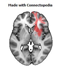 Anterior_corona_radiata_R106