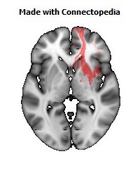 Anterior_corona_radiata_R108