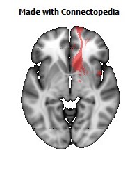 Anterior_corona_radiata_R112