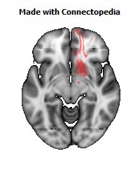 Anterior_corona_radiata_R116