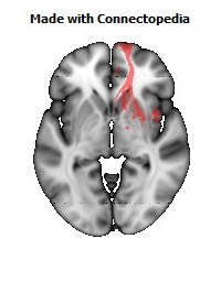 Anterior_corona_radiata_R110