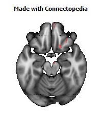 Anterior_corona_radiata_R126