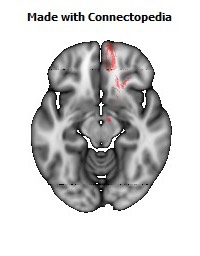 Anterior_corona_radiata_R120