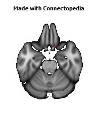 Anterior_corona_radiata_R132