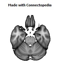 Anterior_corona_radiata_R134