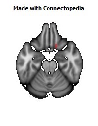 Anterior_corona_radiata_R130