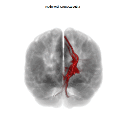 Anterior Limb of Internal Capsule