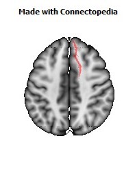 Anterior_limb_of_internal_capsule_R064