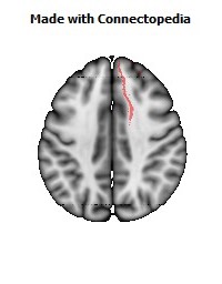 Anterior_limb_of_internal_capsule_R068