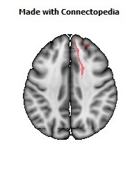 Anterior_limb_of_internal_capsule_R070