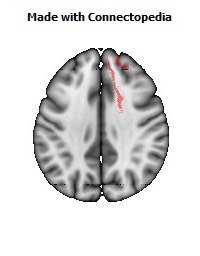 Anterior_limb_of_internal_capsule_R072