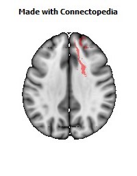 Anterior_limb_of_internal_capsule_R074