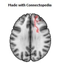 Anterior_limb_of_internal_capsule_R078