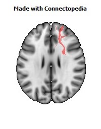 Anterior_limb_of_internal_capsule_R080