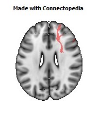 Anterior_limb_of_internal_capsule_R082