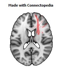 Anterior_limb_of_internal_capsule_R090