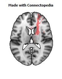 Anterior_limb_of_internal_capsule_R094