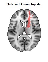 Anterior_limb_of_internal_capsule_R096