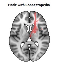 Anterior_limb_of_internal_capsule_R098