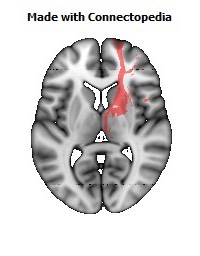 Anterior_limb_of_internal_capsule_R100