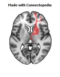 Anterior_limb_of_internal_capsule_R102