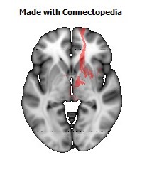 Anterior_limb_of_internal_capsule_R110