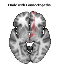 Anterior_limb_of_internal_capsule_R112