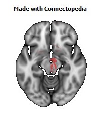 Anterior_limb_of_internal_capsule_R120