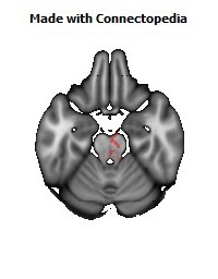 Anterior_limb_of_internal_capsule_R130