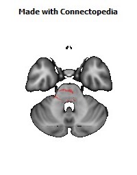 Anterior_limb_of_internal_capsule_R140