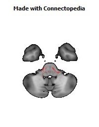 Anterior_limb_of_internal_capsule_R150