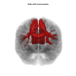 Body of Corpus Callosum