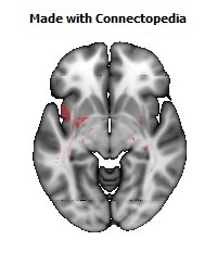 Body_of_corpus_callosum114