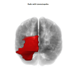 Posterior Cerebral Artery Territory