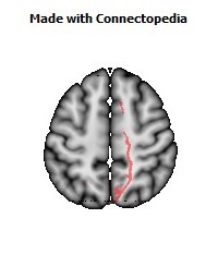 Cerebral_peduncle_R056