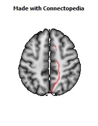 Cerebral_peduncle_R060