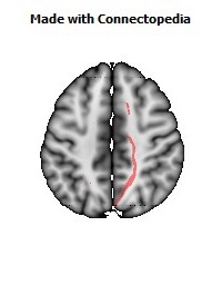 Cerebral_peduncle_R062