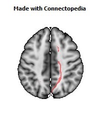 Cerebral_peduncle_R064