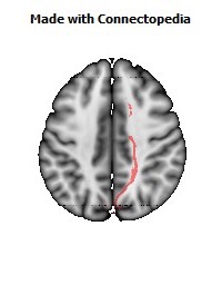 Cerebral_peduncle_R066