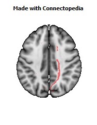 Cerebral_peduncle_R068